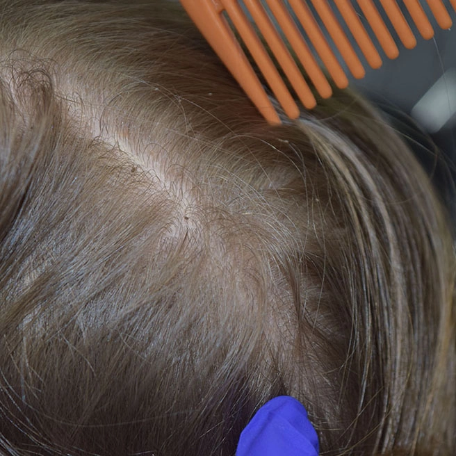 A top down view of someone's blond hair parted with a comb. There are nits attached to several hair shafts. You can see live lice on the scalp.
