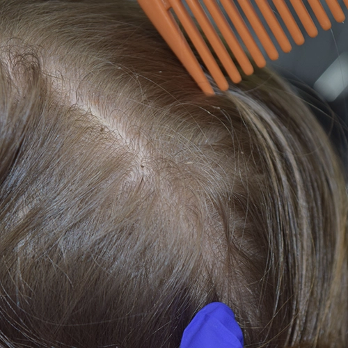 Live lice and nits on blonde hair — close-up photo