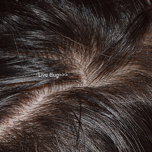 Live louse in dark brown hair — close-up photo
