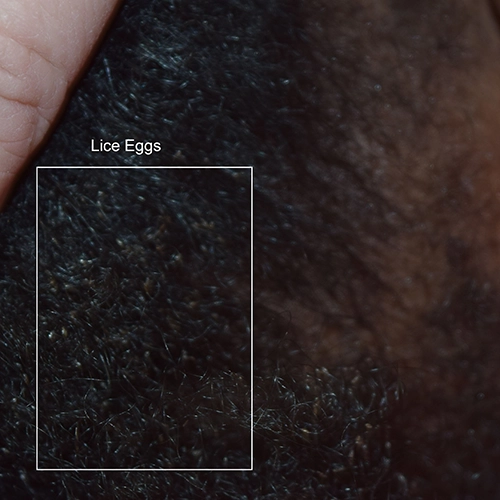 Nits in curly brown hair — second view