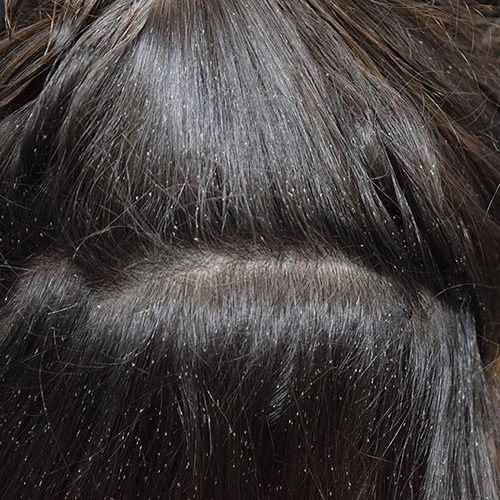 Nits attached to dark brown hair shafts — close-up photo